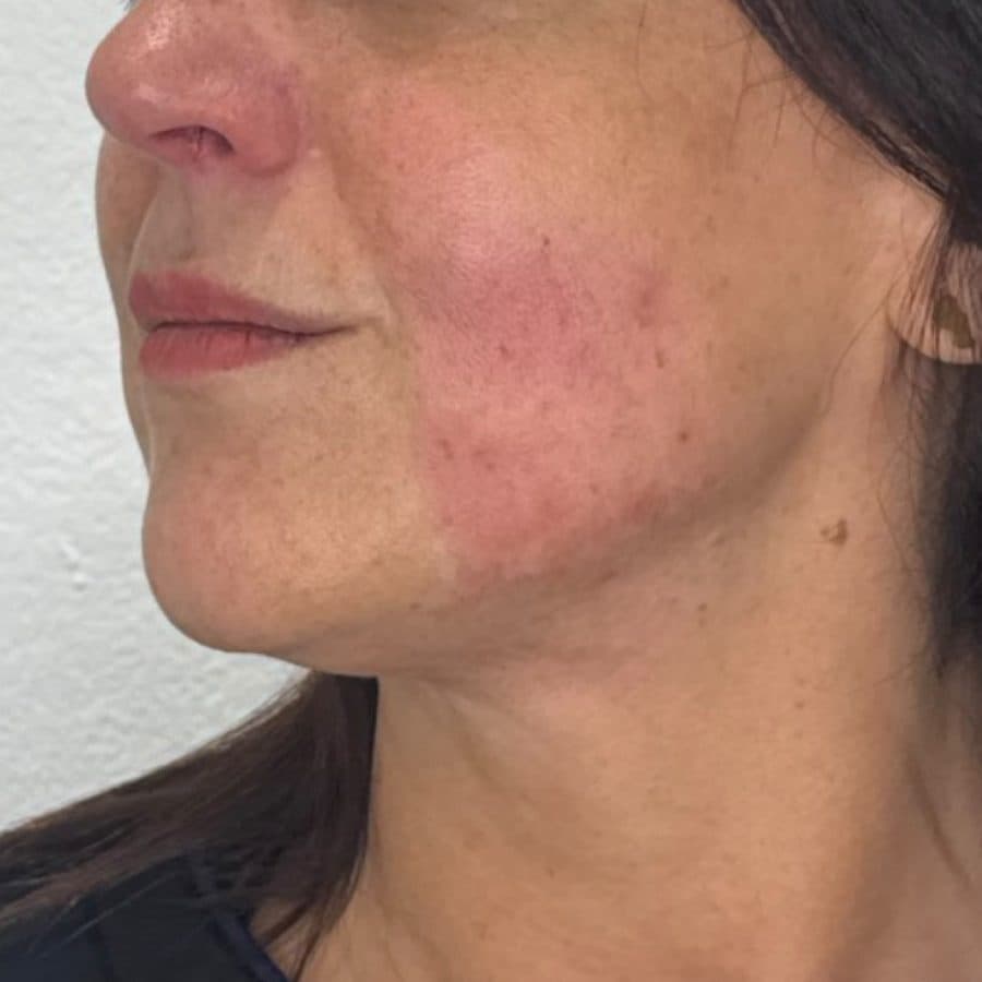 Rostro y cuello antes y después de Cellbooster Shape, caso 1: antes
