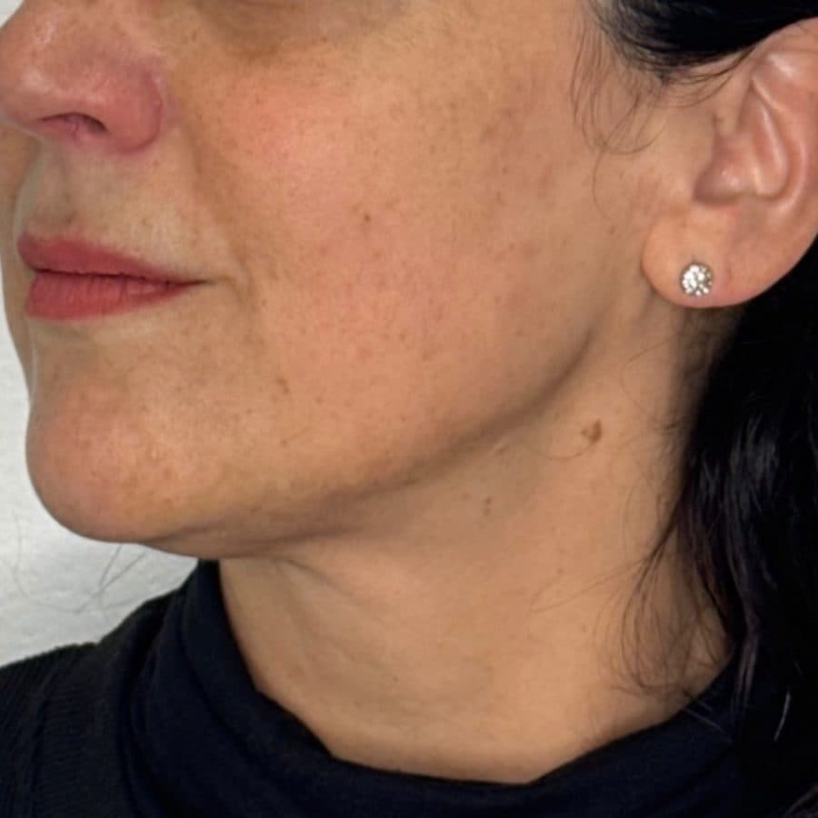 Rostro y cuello antes y después de Cellbooster Shape, caso 1: después