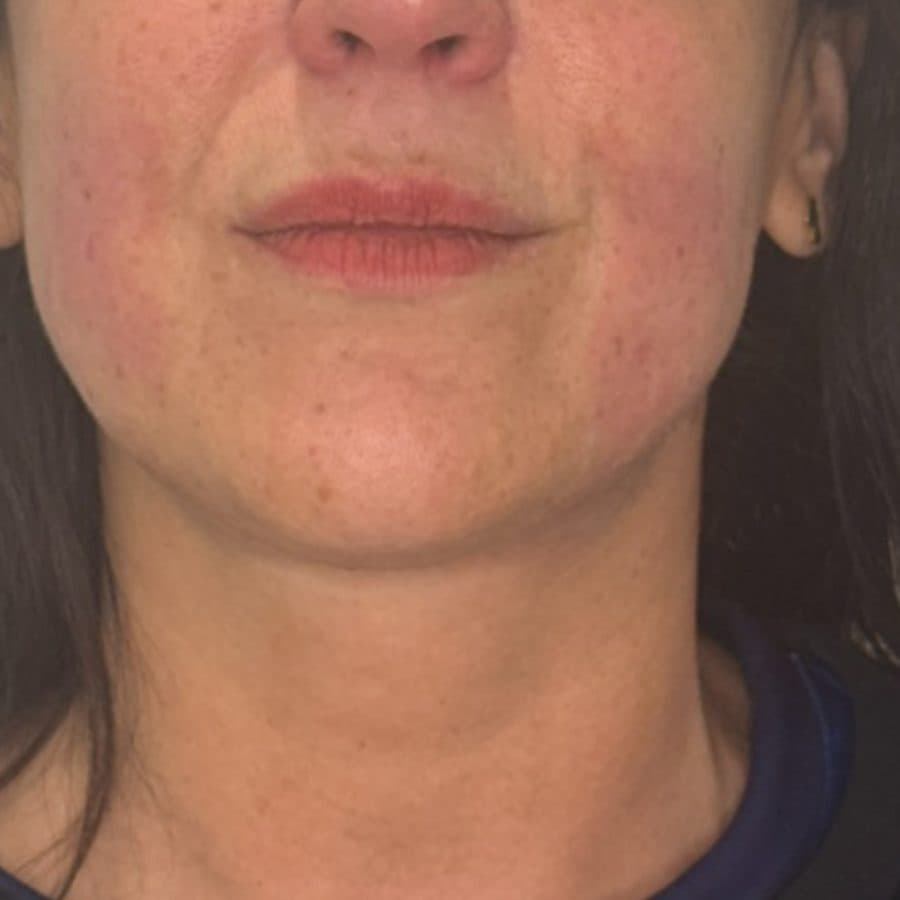 Rostro y cuello antes y después de Cellbooster Shape, caso 2: antes
