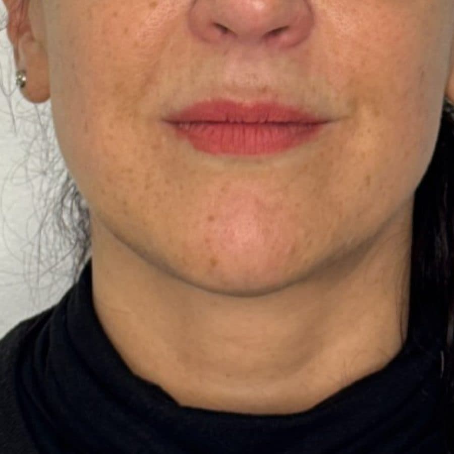 Rostro y cuello antes y después de Cellbooster Shape, caso 2: después