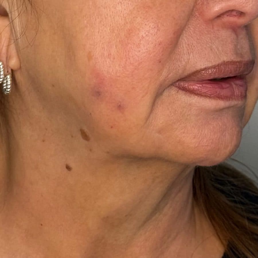 Rostro y cuello antes y después de Cellbooster Shape, caso 4: antes