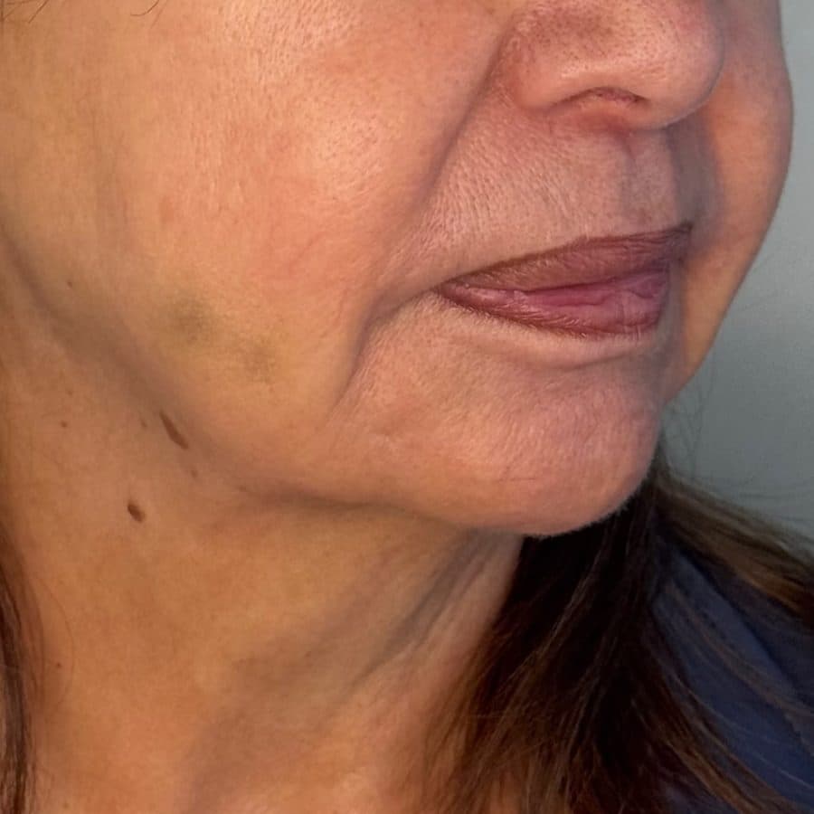 Rostro y cuello antes y después de Cellbooster Shape, caso 4: después