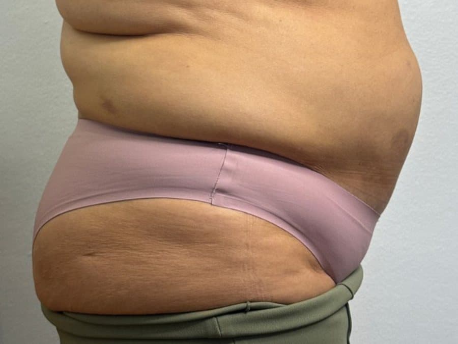 Abdomen y cadera antes y después de las enzimas lipolíticas: antes