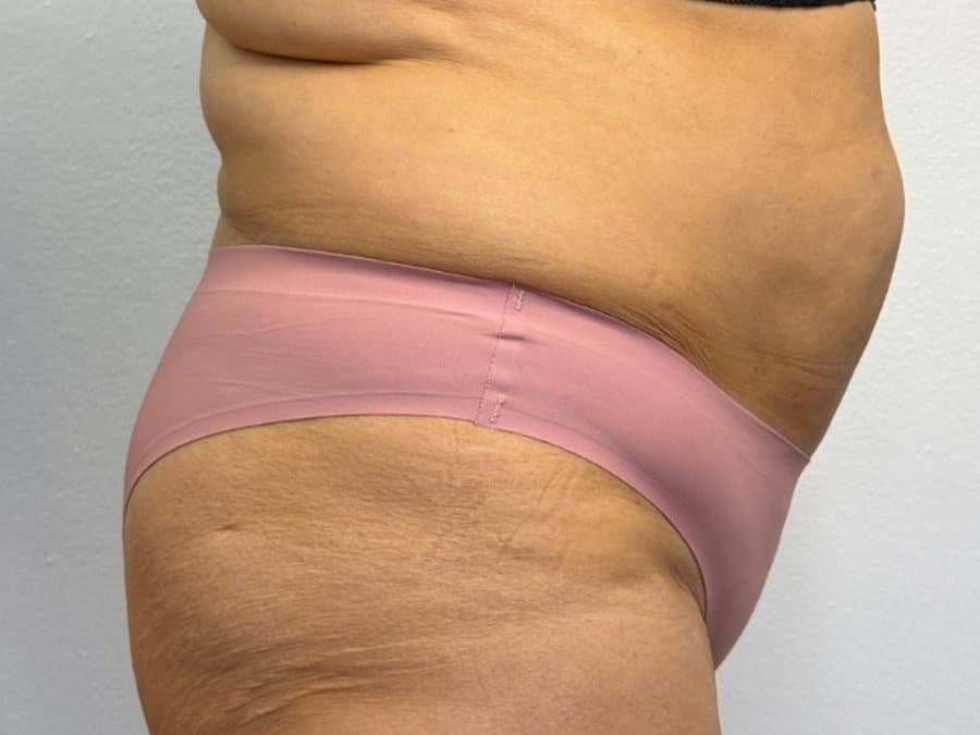 Abdomen y cadera antes y después de las enzimas lipolíticas: después