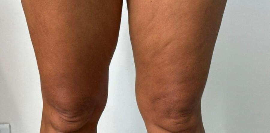 Rodillas y muslos antes y después de la fosfatidilcolina: después