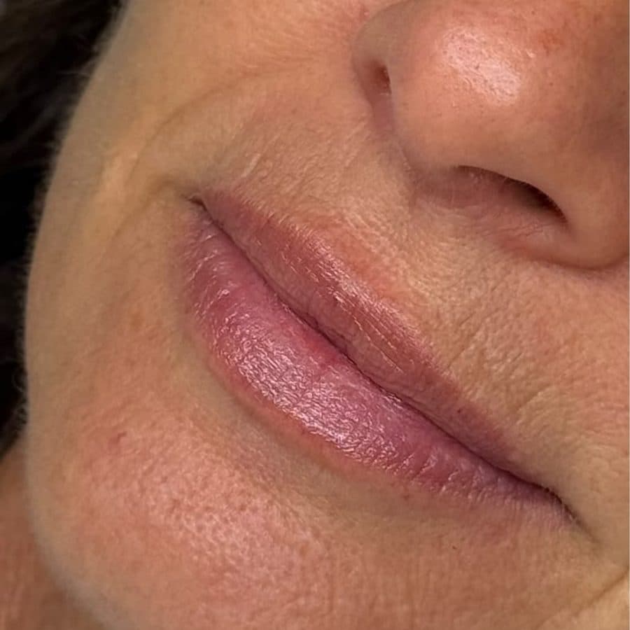 Labios antes y después del relleno, caso 2: antes