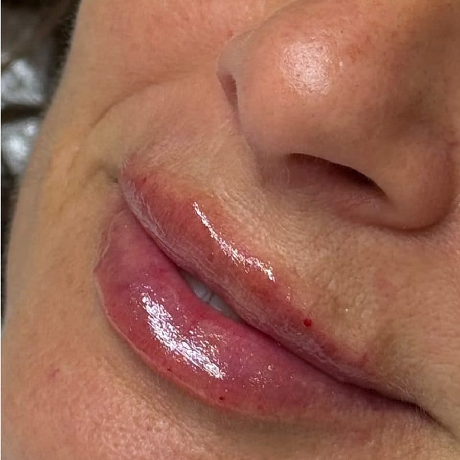 Labios antes y después del relleno, caso 2: después