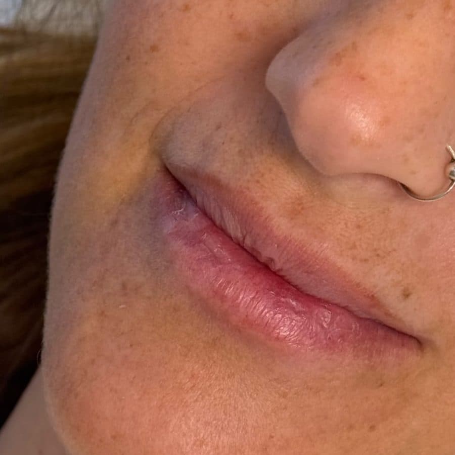 Labios antes y después del relleno, caso 3: antes