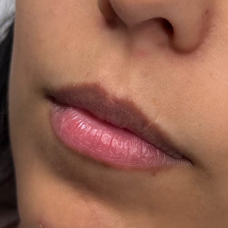 Labios antes y después del relleno, caso 4: antes