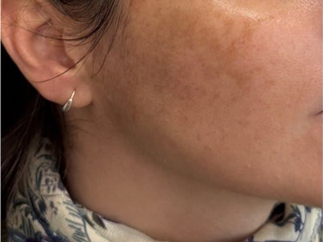 Mejilla con manchas antes y después de Mesopeel: antes