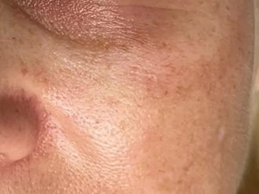 Zona bajo el ojo antes y después de la Mesoterapia NCTF para ojeras: antes