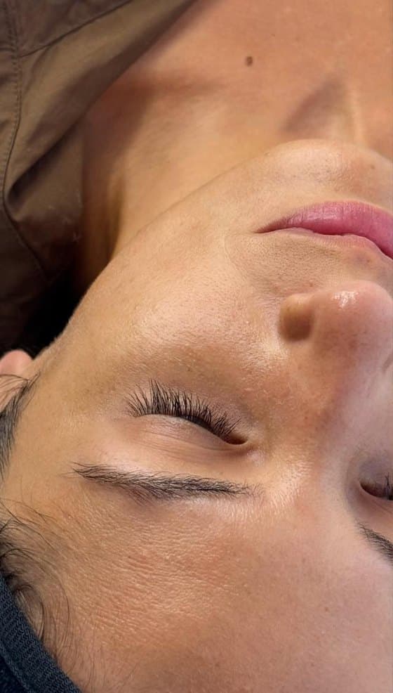 Rostro antes y después del plasma rico en plaquetas facial: antes