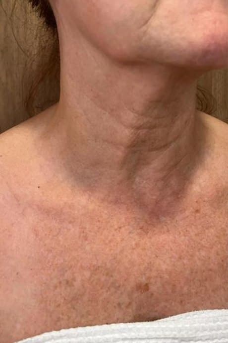 Cuello y escote antes y después de Sculptra: antes