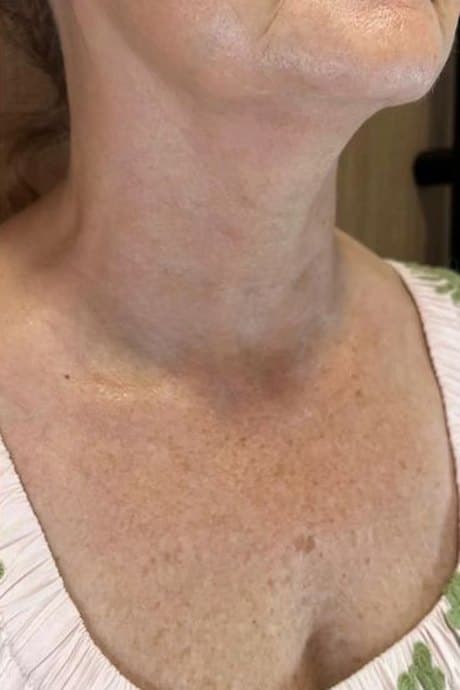 Cuello y escote antes y después de Sculptra: después