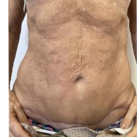 Abdomen antes y después de Sculptra: antes