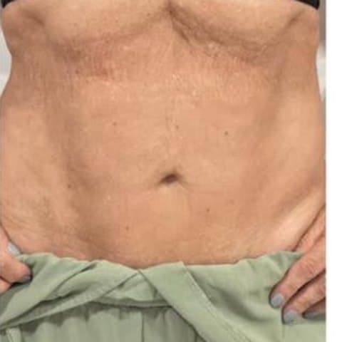 Abdomen antes y después de Sculptra: después