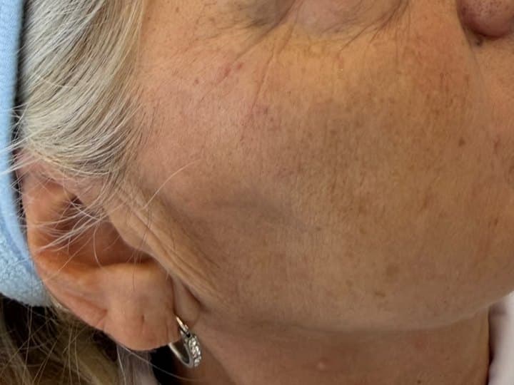 Piel del contorno del ojo antes y después del Skinbooster: después