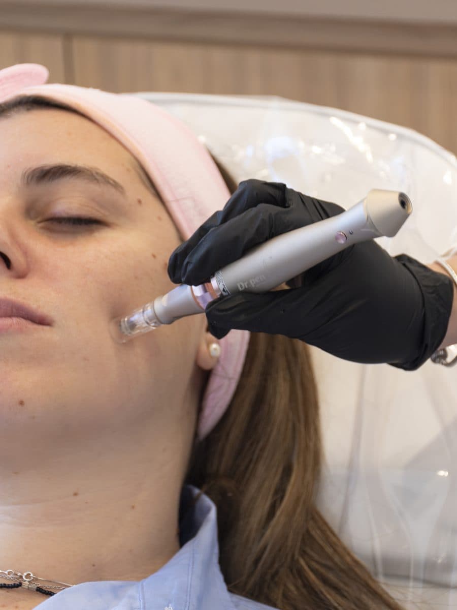 Dermapen aplicado en la mejilla